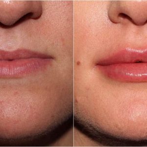 Before and after image of injectable services from The Skin Wellness Center in Knoxville TN